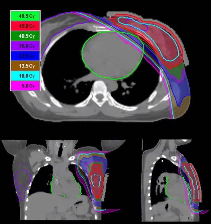 The TOMO treatment experience on the left side of the breast cancer in Taiwan dongya hospital